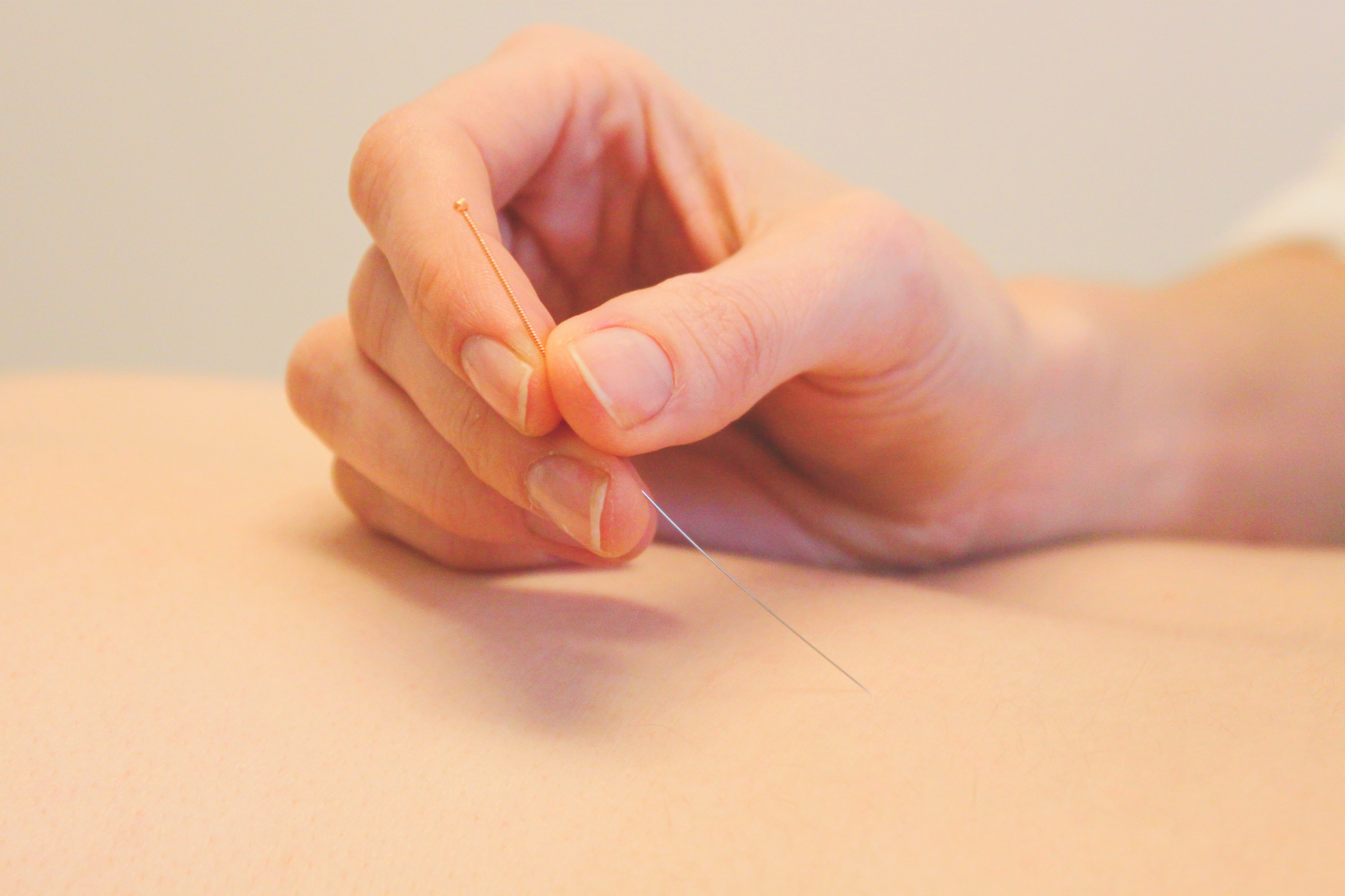 Acupunctuur behandeling
